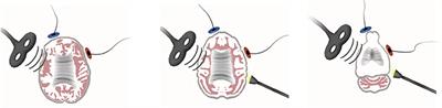 Novel Neuromodulation Techniques to Assess Interhemispheric Communication in Neural Injury and Neurodegenerative Diseases